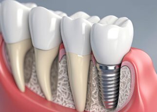 Historia implantologii zębowej